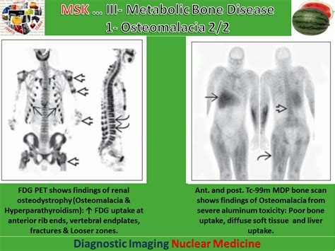 Easy Radiology: Metabolic bone disease