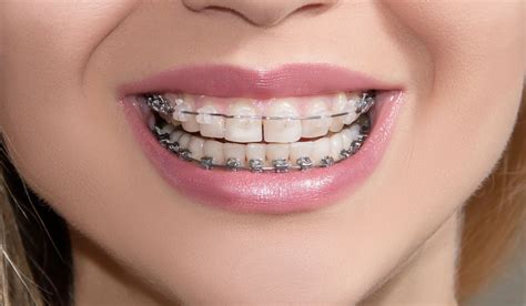 Getting A Gap After Braces: What's The Cause & How To Prevent It