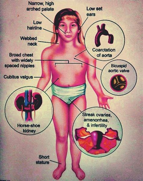 Turner Syndrome Nursing Care Management - Nurseslabs