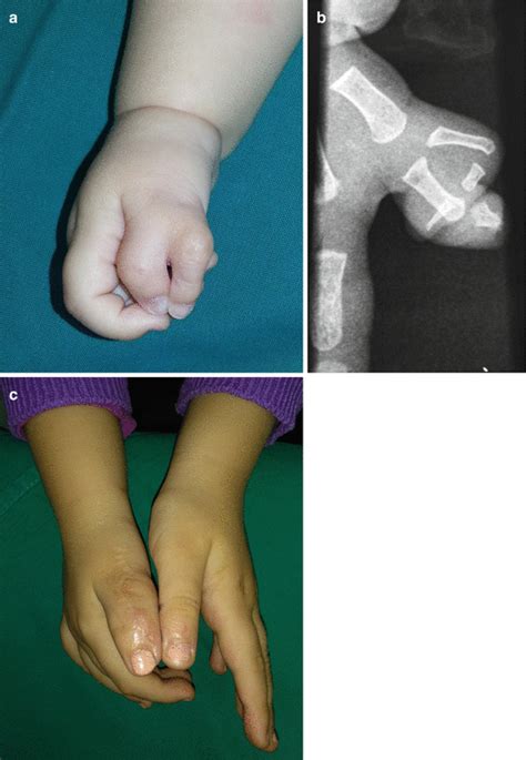 Polydactyly | Plastic Surgery Key