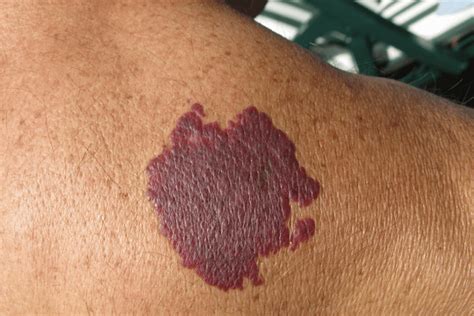 Port Wine Stain Treatment Scottsdale | Birthmark Removal