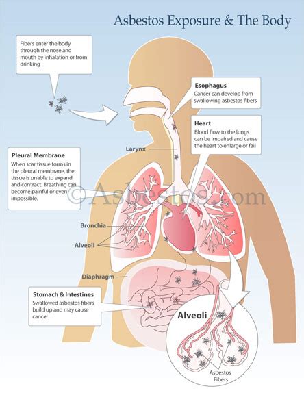 Asbestos Exposure Signs, Symptoms & Risks- Long Term Exposure ...