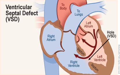 Ventricular Septal Defect Types