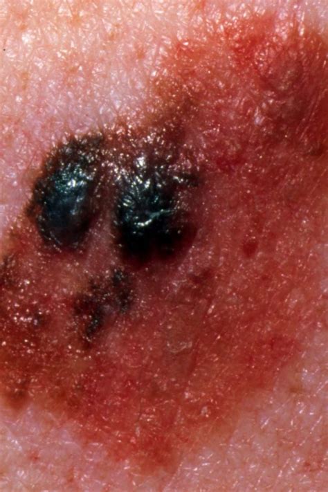 Melanoma Stage 4