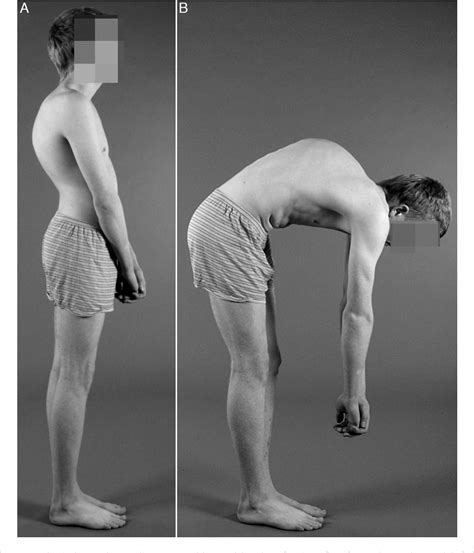 Figure 1 from [Current concepts on Scheuermann kyphosis: clinical ...