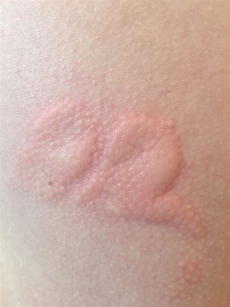 this welt on my skin that looks like a baby : r/mildlyinteresting