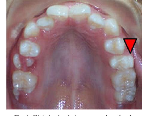 Figure 4 from Paramolar tubercle in the left maxillary second premolar ...