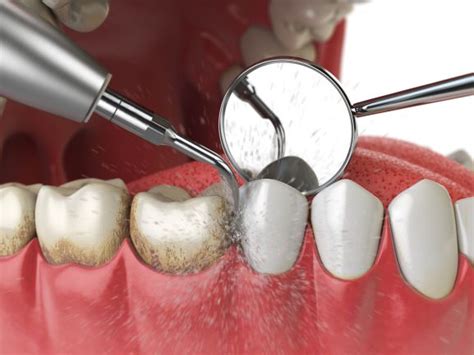 Dental Plaque Removal