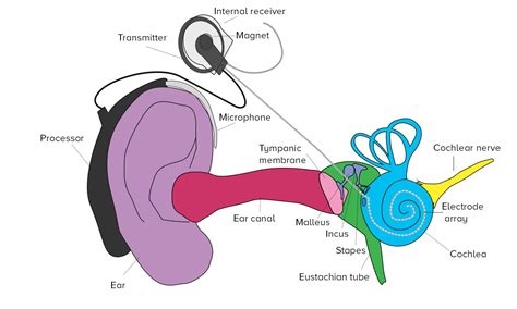 What Do Cochlear Implants And Hearing Aids Sound Like?