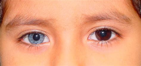 Heterochromia: What is it, Causes, Types, Risk Factors and Treatment