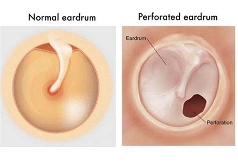 Let’s talk about ruptured eardrum – what is it and how to treat it ...