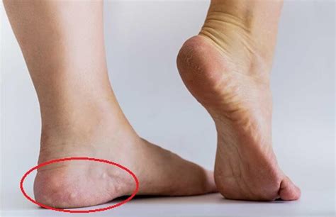 Pedal Piezogenic Papules: Causes, Symptoms & Treatment