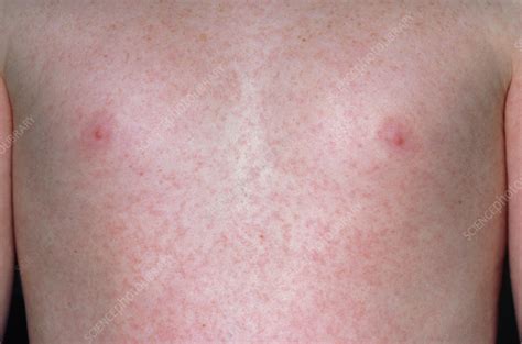 German measles (Rubella) rash on chest of a child - Stock Image - M210 ...