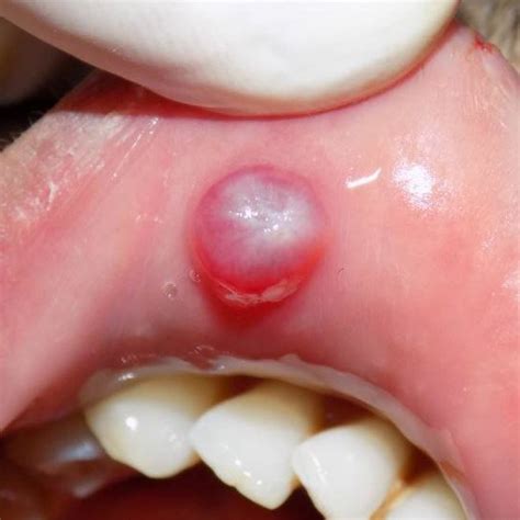 (PDF) MANAGEMENT OF LIP MUCOCELE – USING MICROSURGERY AND LASER