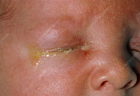 Newborn baby with sticky eye or conjuctivitis - Stock Image - M155/0158 ...