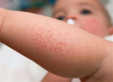 Meningitis Rash On Face / From Meningitis To Eczema And Measles The ...