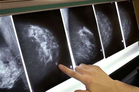 Got dense breasts? That can depend on who is reading the mammogram ...