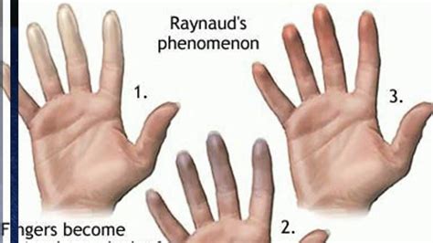 Raynaud's Disease: Symptoms, Causes And Treatments | Faculty of ...