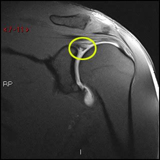 MRI Arthrogram Shoulder: Rule Out Labral Tear | Cedars-Sinai