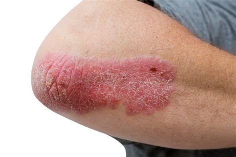 Deucravacitinib Therapy May Address Plaque Psoriasis When Apremilast ...