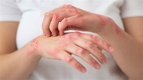 Psoriasis: Expert Explains Symptoms, Complications, And Treatment ...