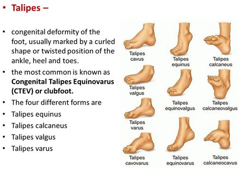 Notes on Clubfoot and Talipes Equiovarus | PCL Nursing 2nd year ...