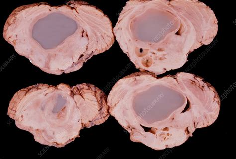 Pilocytic astrocytoma - Stock Image - C057/3087 - Science Photo Library