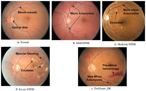 Diagnostics | Free Full-Text | Hybrid Methods for Fundus Image Analysis ...