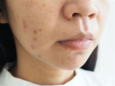 Why Does Acne Cause Hyperpigmentation? | Justinboey