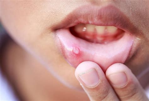 14 Home Remedies for Mouth Ulcers in Babies & Children