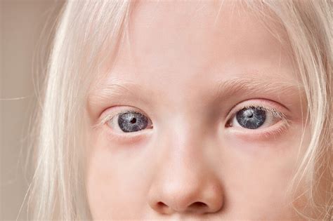 Albino Eye Color: Understanding Its Unique Appearance