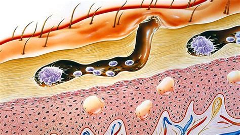 Escabiosis