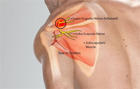 Scapular Nerve Impingement Symptoms - Dermatomes Chart and Map