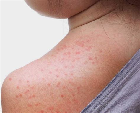 Suffering From Sweat Rashes? These Home Remedies Will Cure & Soothe You ...