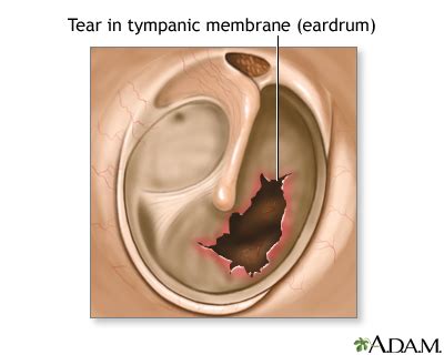 Tympanic Membrane Perforation Repair