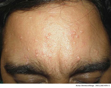 Sebaceous Gland Hyperplasia (Sebaceous Hyperplasia, Senile, 60% OFF