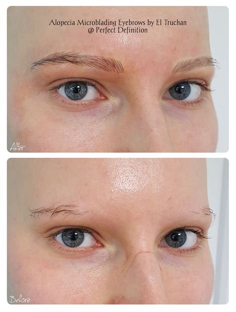 How Long Does It Take For Eyebrows To Grow Back After Alopecia ...