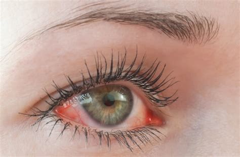 Chemosis: Causes, symptoms and treatment - All About Vision