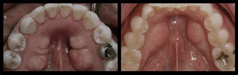 Mandibular Tori, Causes and Treatment - Pro Teeth Guard