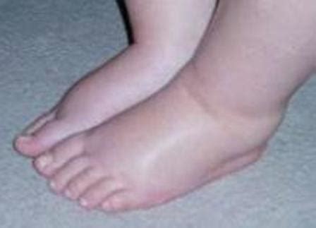 What causes Swollen Ankles? – What causes this?