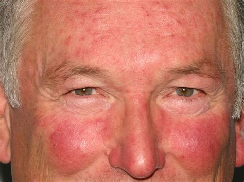 Rosacea - Causes, Symptoms, Cream, Diet & Rosacea Treatment