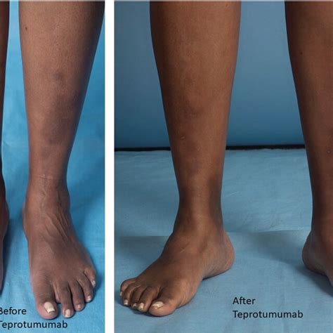 Showing pretibial myxedema before and after teprotumumab. | Download ...