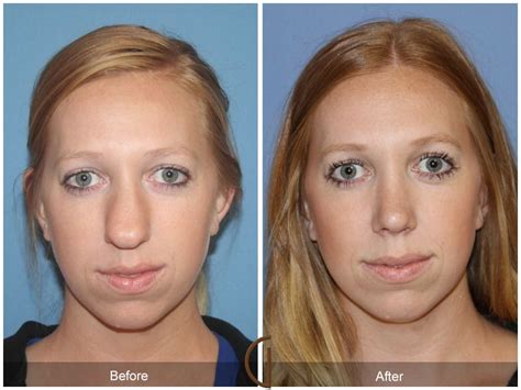 alar skin graft rhinoplasty Google Search Nose surgery