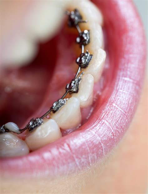 Lingual Braces: History and Benefits - Belmar Orthodontics