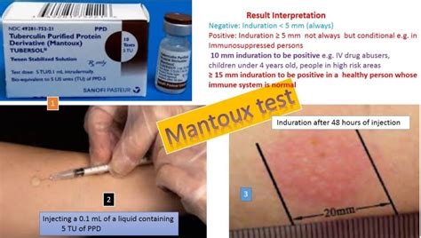 Mantoux test: Introduction, procedure, normal range and result interpret