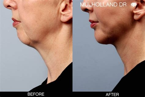 Chin Implants Before & After Photo Gallery | TPS