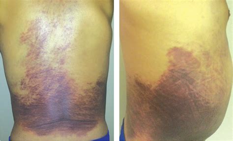 Ecchymosis Vs Hematoma