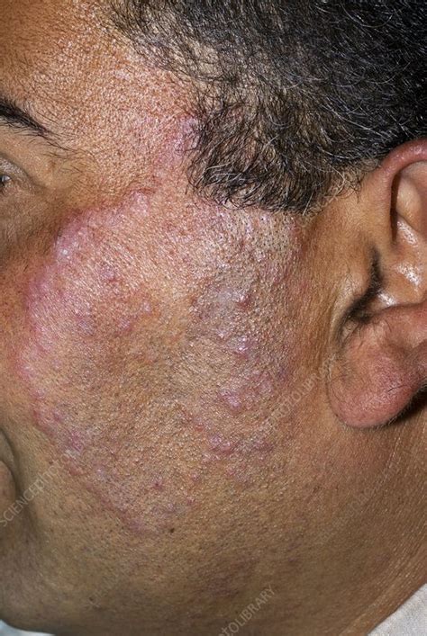 Tinea fungal infection on the face - Stock Image - C010/3378 - Science ...