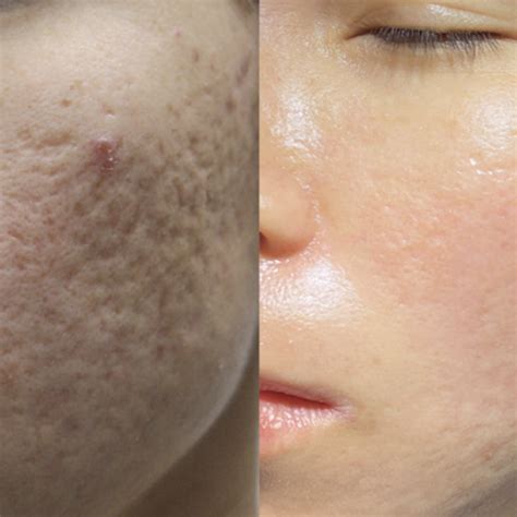 Acne Scar & Pore Reduction Laser Treatment Melbourne