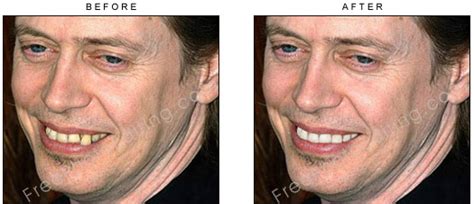 38+ Steve Buscemi Teeth Fixed Pics